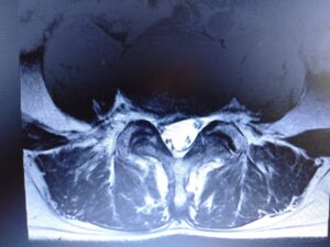 椎間板ヘルニアのMRI画像２